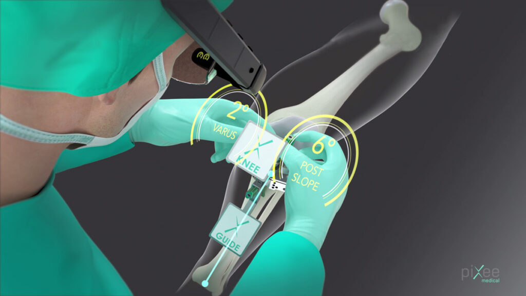 Knee+: Ρομποτική Αρθροπλαστική γόνατος με τεχνολογία VR !